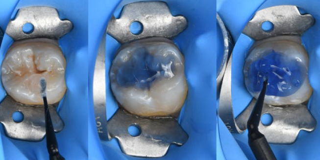 Fig. 6: Stamp production with liquid rubber dam.